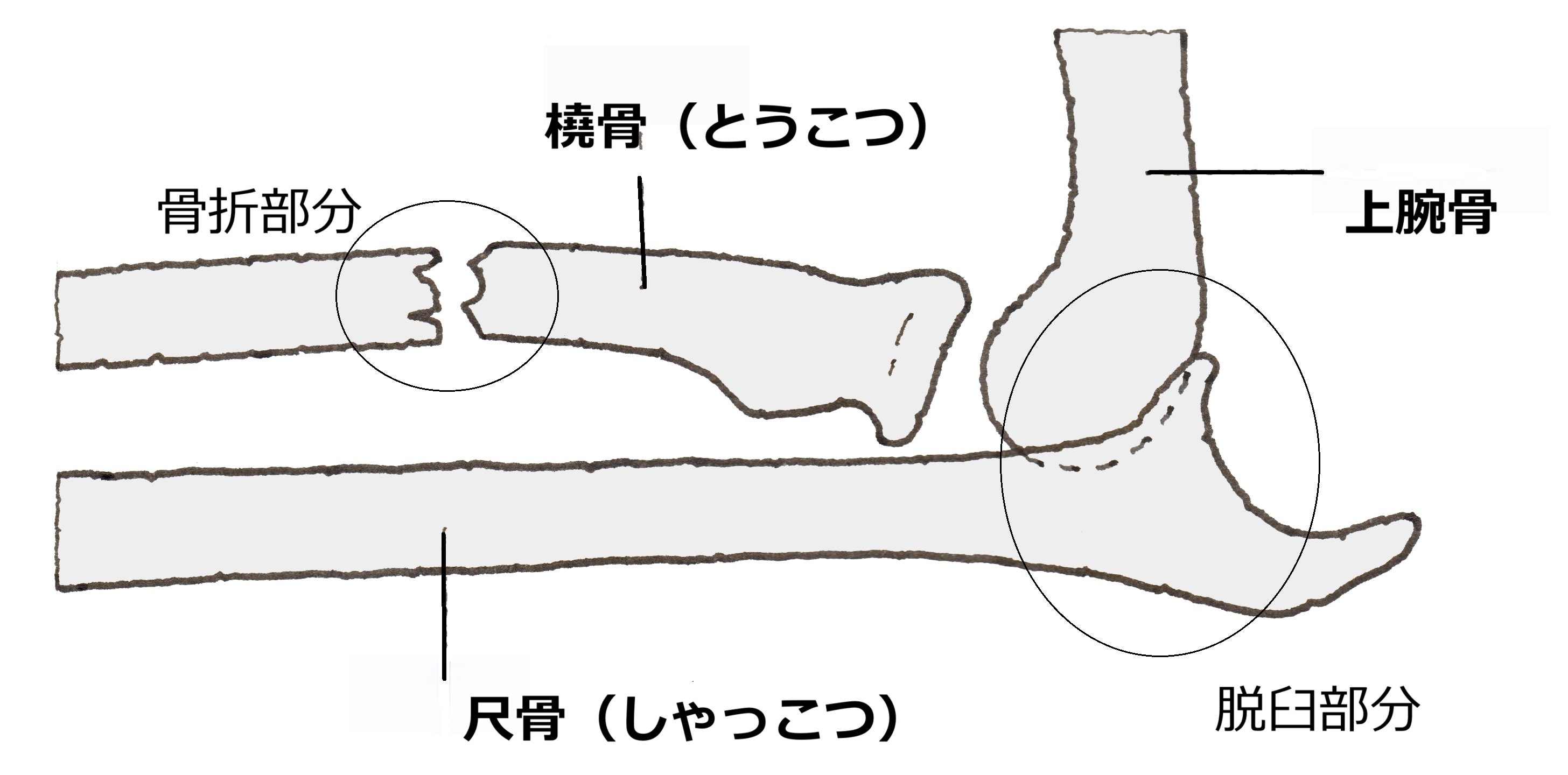 ガレアッチ骨折