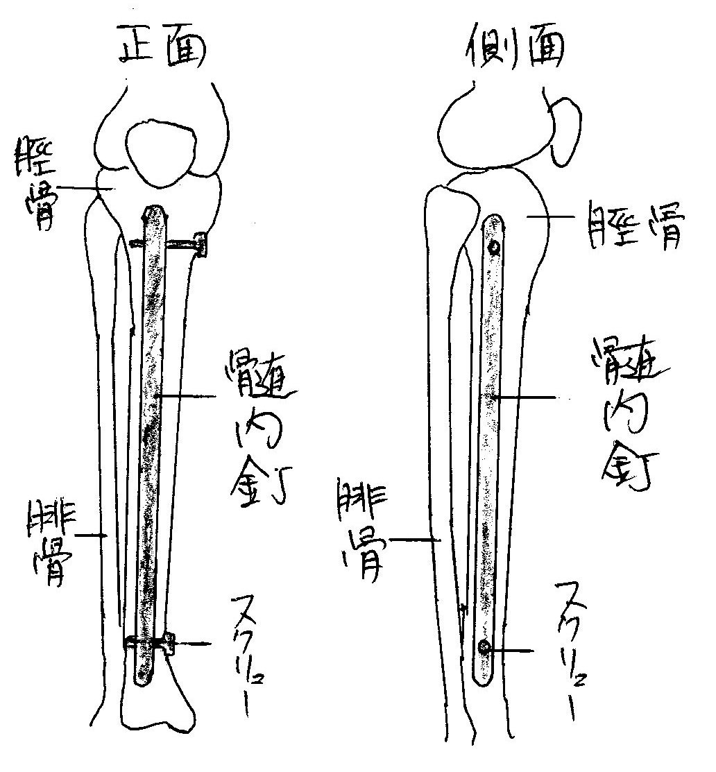 髄内釘